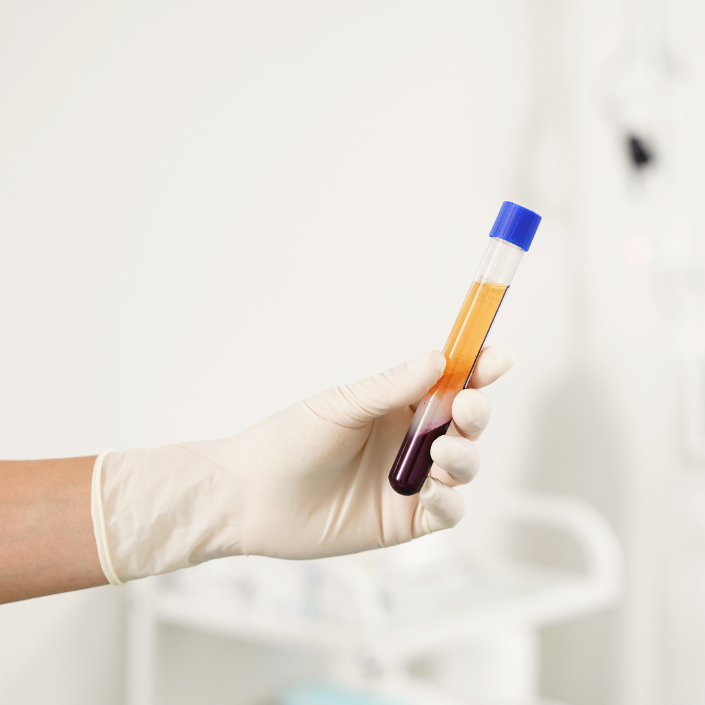 Platelet rich plasma or PRP for sexual rejuvenation 1