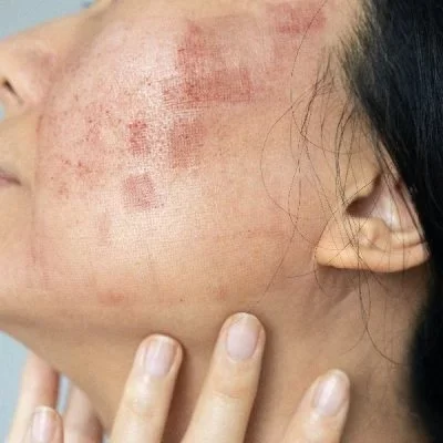 facial skin treatmen in florida