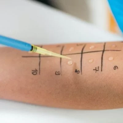 allergy skin prick testing
