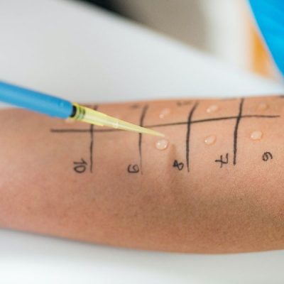 Allergy - Skin Prick Tests on a Woman’s Arm